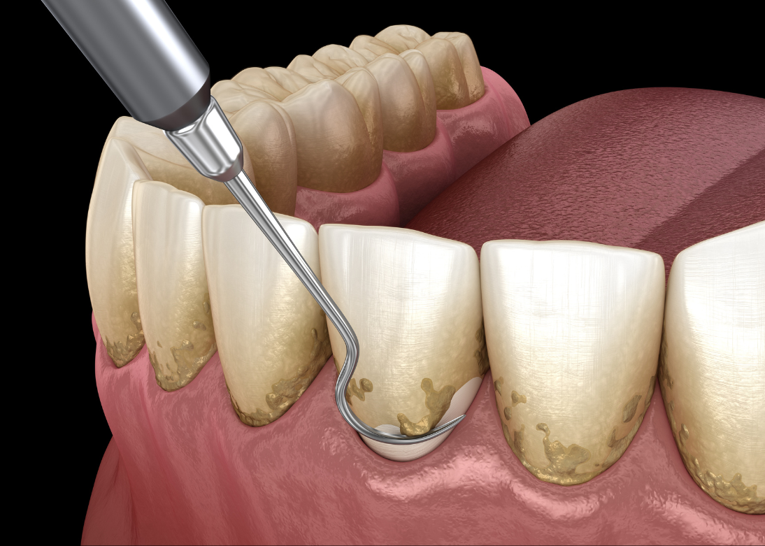 Teeth Cleaning